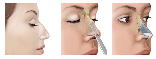 chirurgie nez