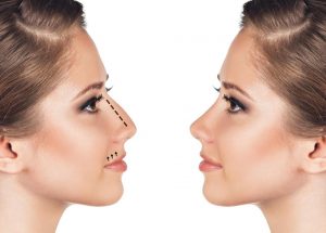 rhinoplastie tunisie