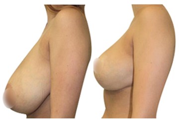 Elevación de mamas Turquía antes y después