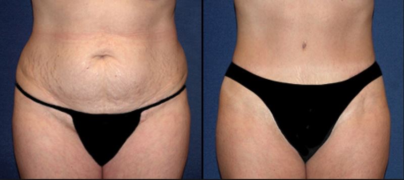 Mini-Abdominalplastik Mini-Bauchdeckenstraffung