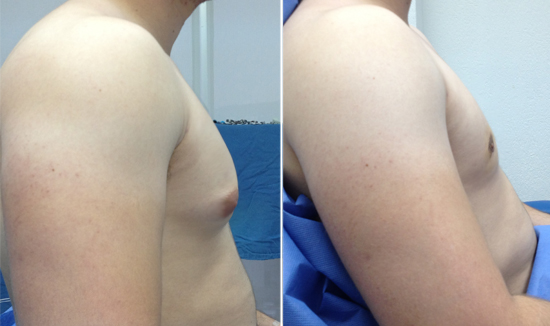 resultat gynecomastie