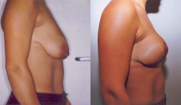 Résultat réduction mammaire Turquie
