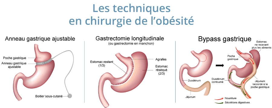 techniques chirurgie obésité