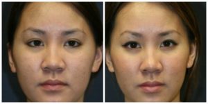 Avant et après rhinoplastie ethnique Turquie