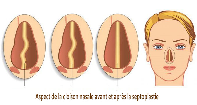 septoplastia