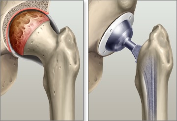 operación de prótesis de cadera