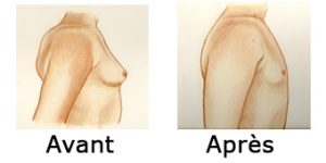 gynecomastie avant et après