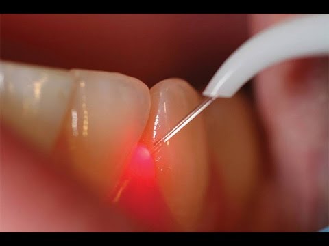 gingivectomie Laser Tunisie