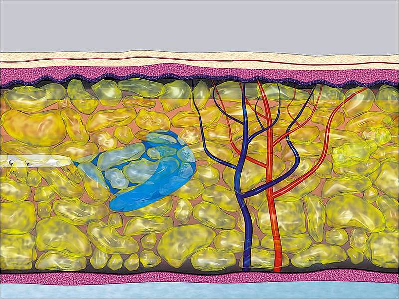 liposucción por chorro de agua