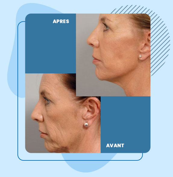 facelift avant et après