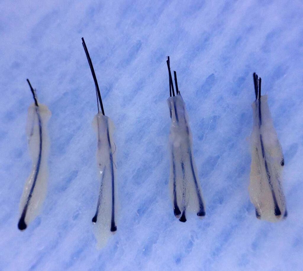 implants-capillaires-greffons