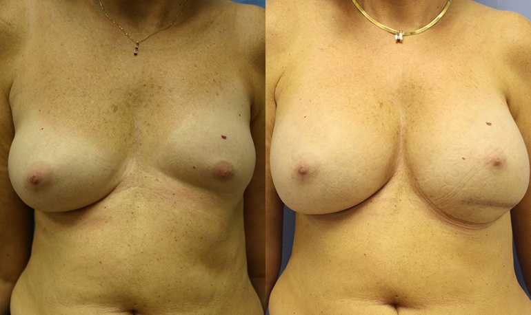 correction-asymetrie-seins-turquie