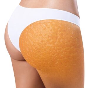 Liposuccion graisse sous la peau