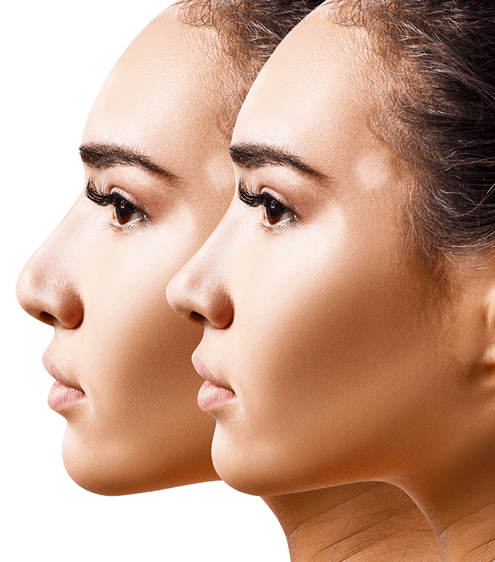 resultat-rhinoplastie-pointe-du-nez-turquie