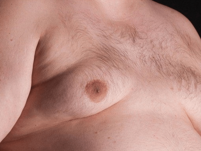 liposuccion-gynecomastie-istanbul-prix