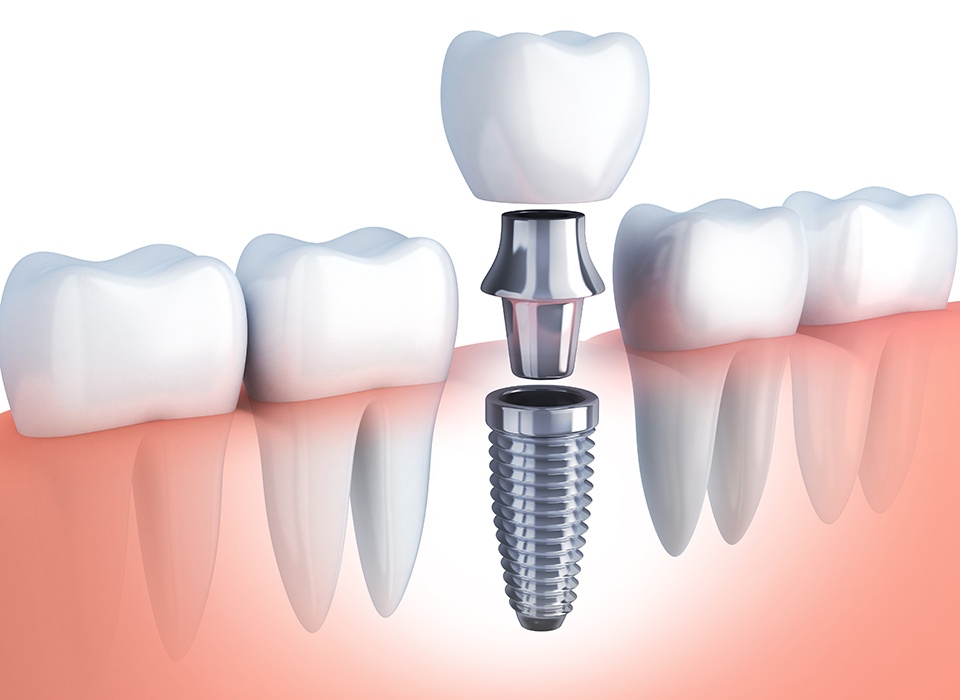 Implant-dentaire-budapest-hongrie