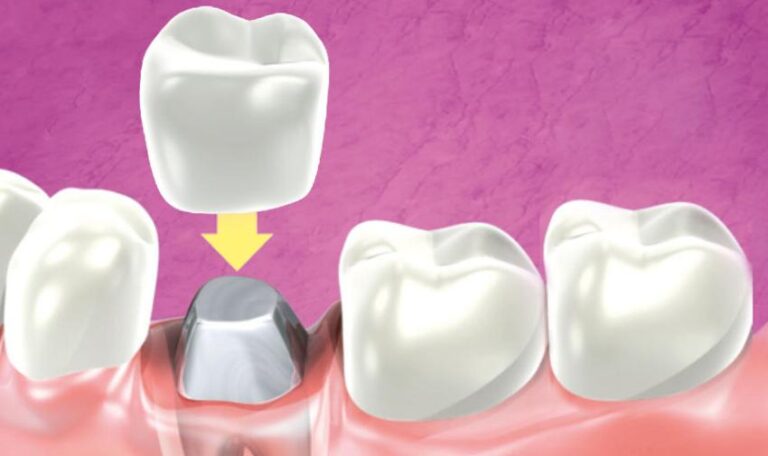 Prix dent sur pivot Inly-Core en Turquie