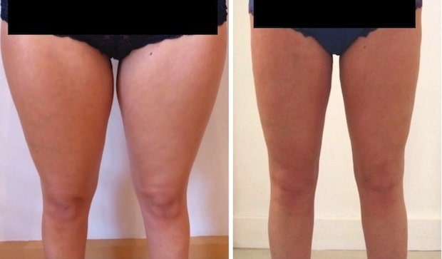 resultat-lipoaspiration-cuisses